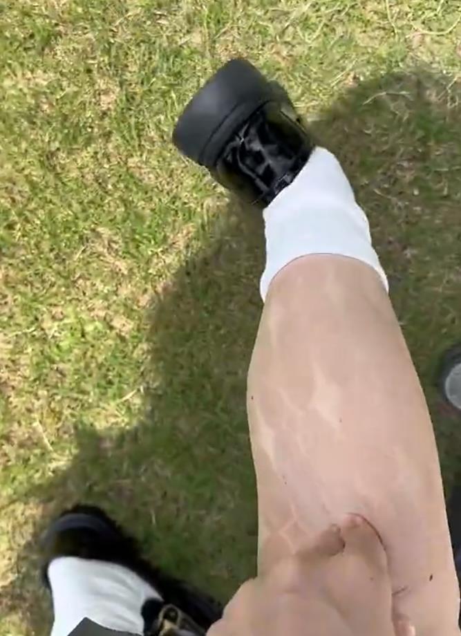 女生穿白色丝袜拍照两小时,喜提“半永久纹身”:烈日太毒太晒